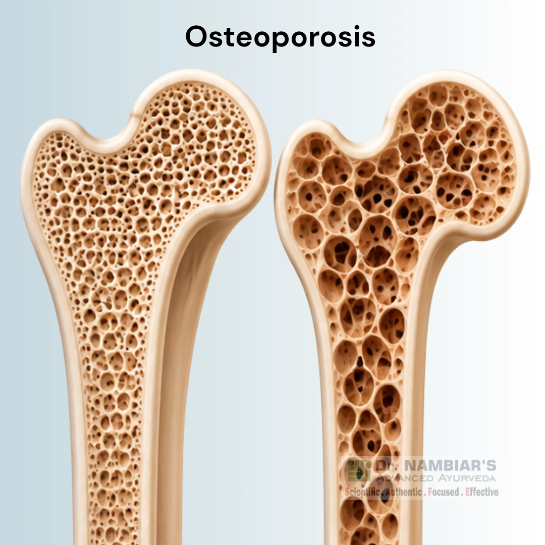 Osteoporosis Treatment